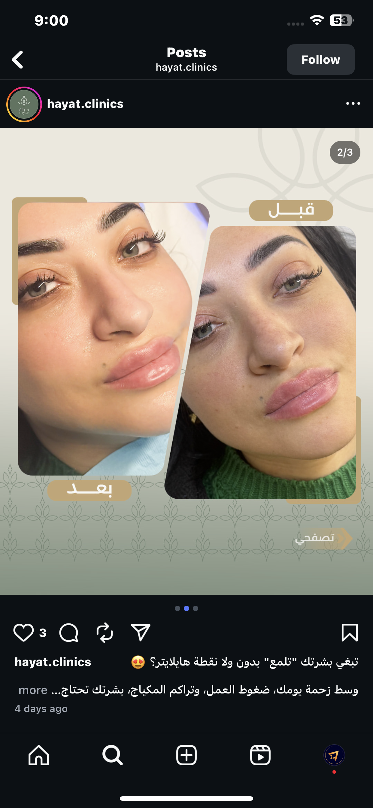 نتيجة هيدرافيشل - قبل وبعد - عيادات حياة الرياض