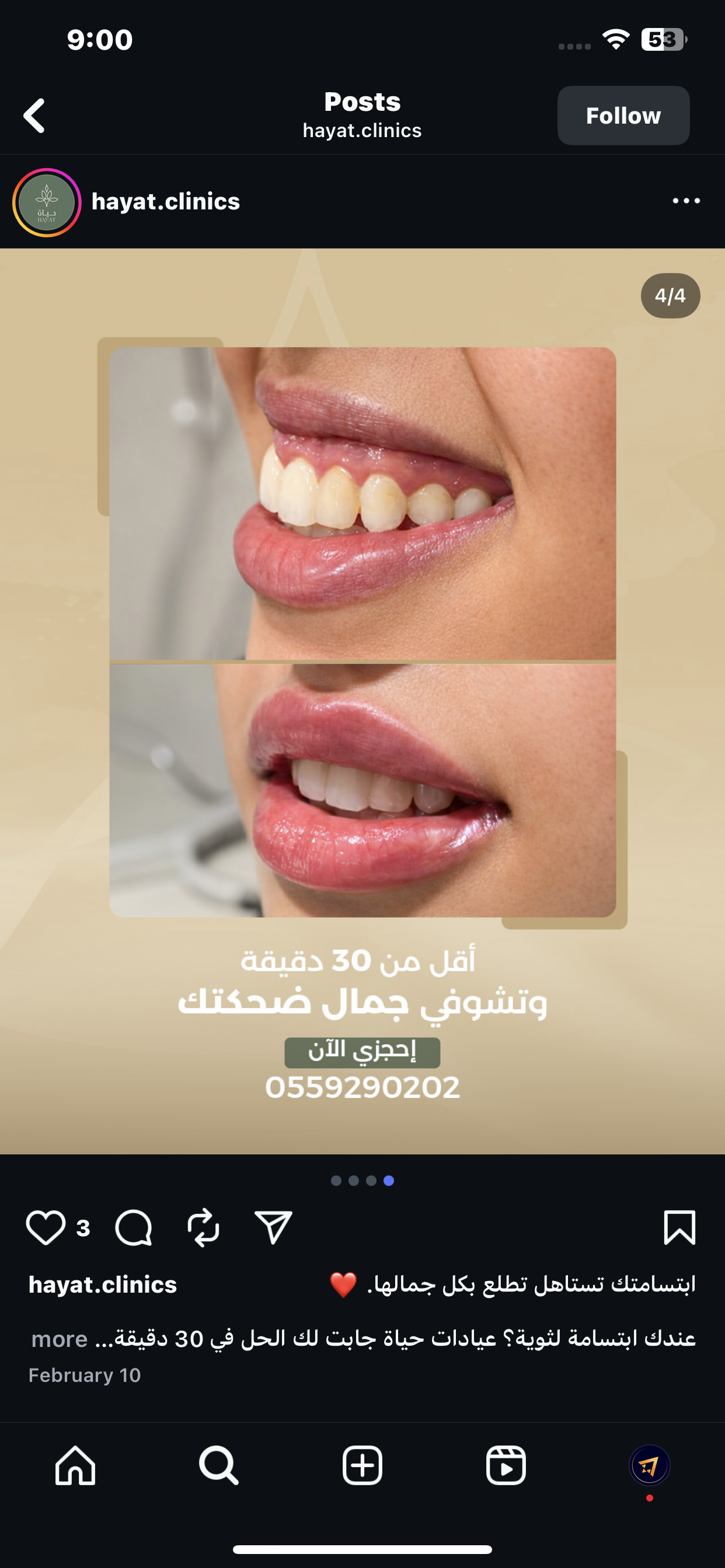 نتيجة علاج الابتسامة اللثوية - قبل وبعد - عيادات حياة الرياض